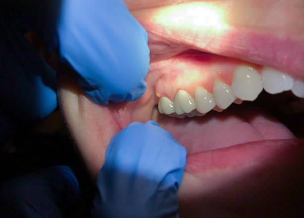 Best Dentist for Tooth Abscess  in Yoakum, TX