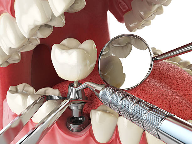 Best Chipped Tooth Repair Near Me  in Yoakum, TX